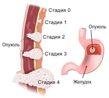 рак желудка стадии