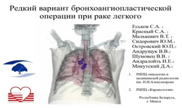 Redkij Variant Bronkhoangioplasticheskoj 0