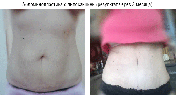 body contouring 1