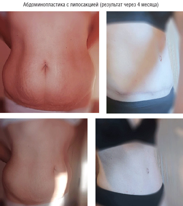 body contouring 2
