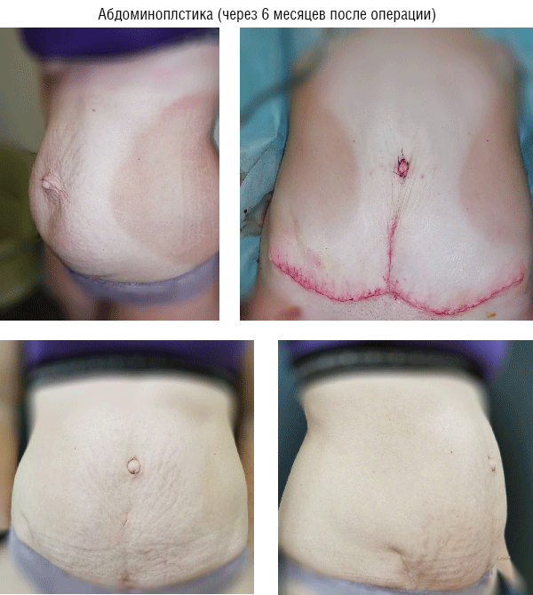 body contouring 3