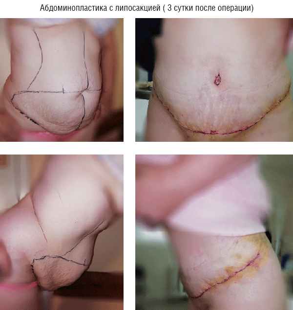 body contouring 4