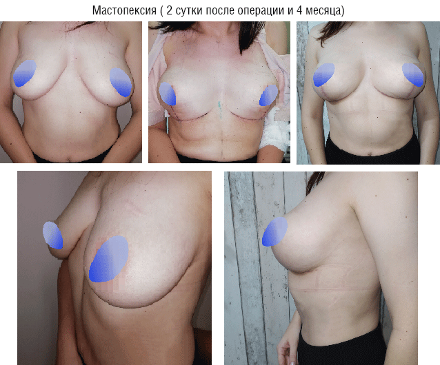 body contouring 5