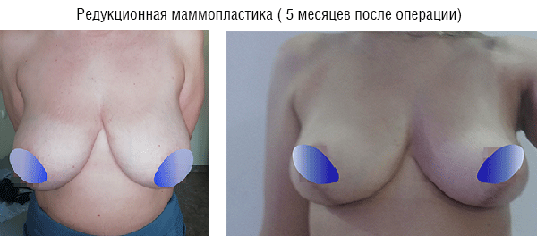 body contouring 6
