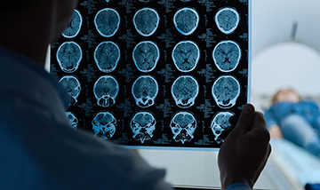 Arteriovenoznye Malformatsii Avm Golovnogo Mozga 0