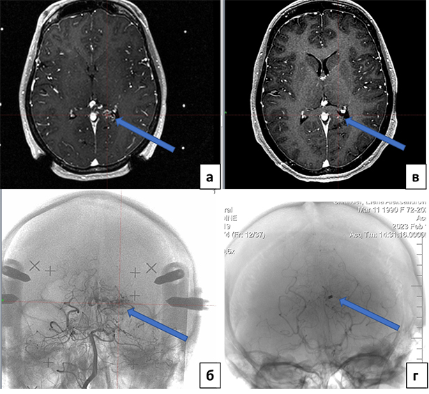arteriovenoznye malformatsii avm golovnogo mozga 1