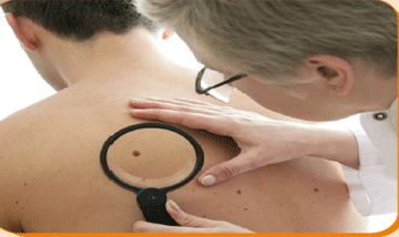 Melanoma