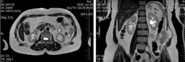 liposarkoma 2