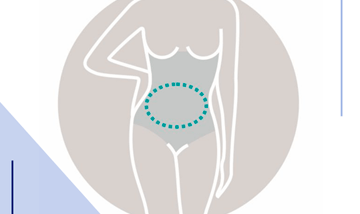Abdominoplastika 0