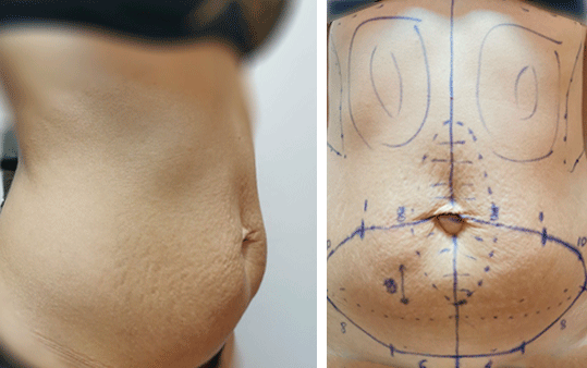 abdominoplastika 1