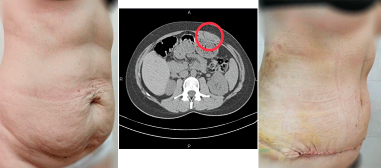 abdominoplastika 10