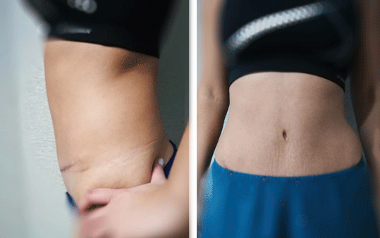 abdominoplastika 2