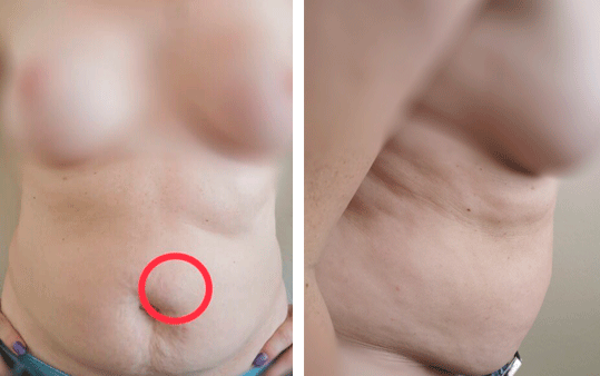 abdominoplastika 3