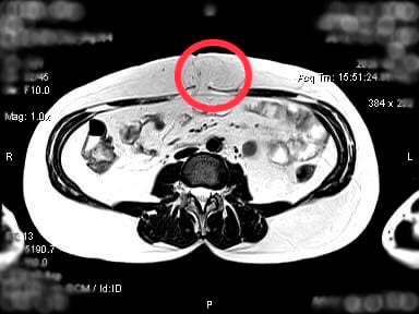 abdominoplastika 4
