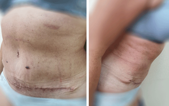 abdominoplastika 5