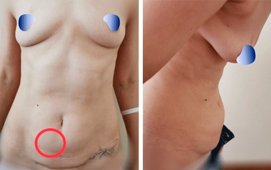 abdominoplastika 6