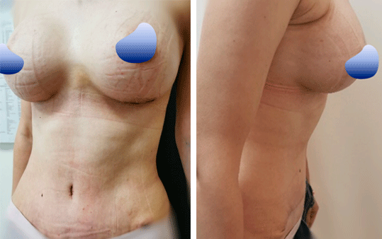 abdominoplastika 7