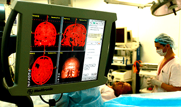 Meningioma 0