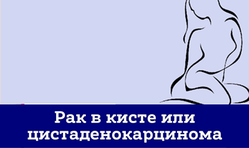 Rak V Kiste Ili Tsistadenokartsinoma