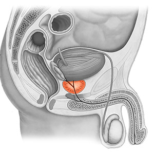 Prostata1