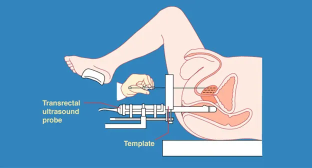 /images/treatments/urologia/rak-prostaty-lechenie.webp