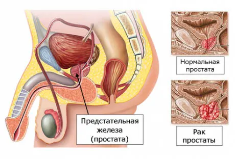 рак простаты