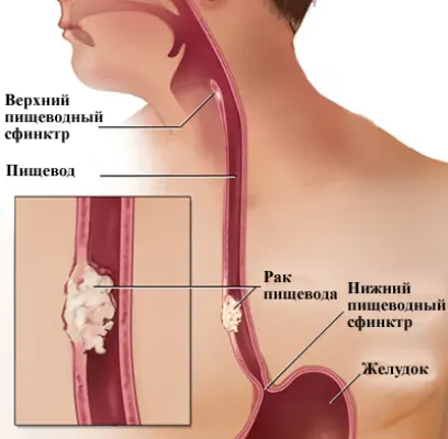 рак пищевода