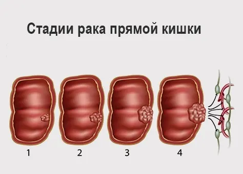 стадии рака прямой кишки