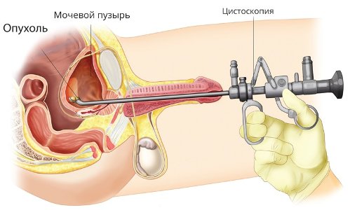 диагностика рака мочевого пузыря