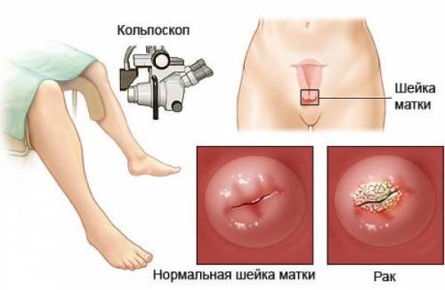 диагностика рака шейки матки