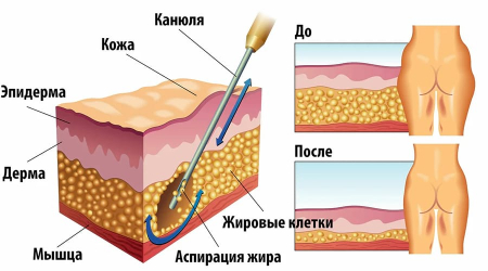 липосакция3