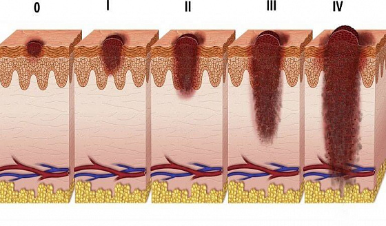 меланома стадии