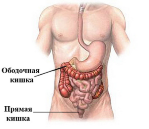 ободочная кишка рак