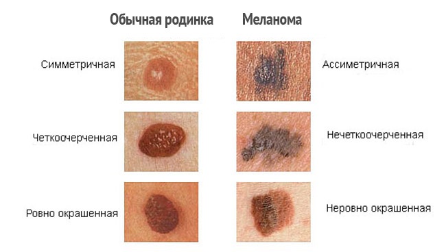 отличия меланомы от родинки фото