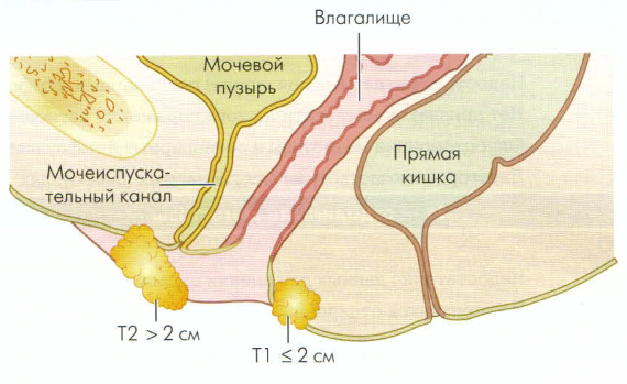 рак вульвы