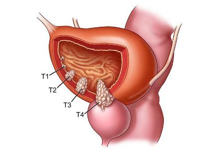рак мочевого пузыря