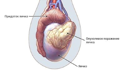 лечение рака яичка