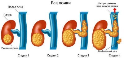 стадии рака почки 1